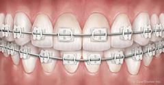 Invisalign Clear Braces & Aligners