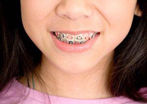 Orthodontics for Teens & Adolescents in Merced