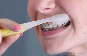 Braces & Orthodontics: How to Properly Bruch