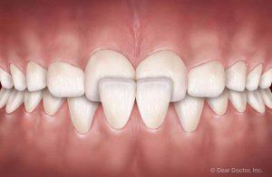 Common Orthodontic Problems - Crossbite | Orthodontics Exclusively