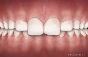 Common Orthodontic Problems - Overbite | Orthodontics Exclusively